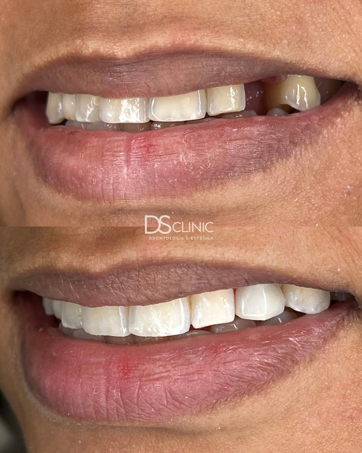 Antes e depois de implante anterior