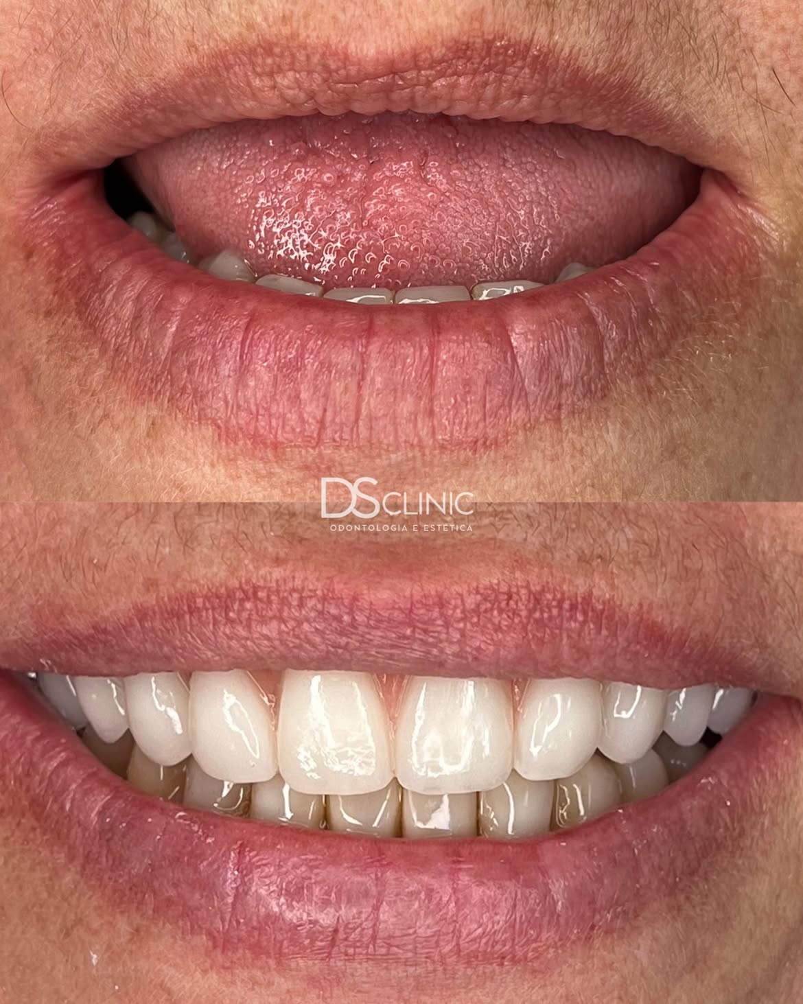Antes e depois de protocolo sobre implantes